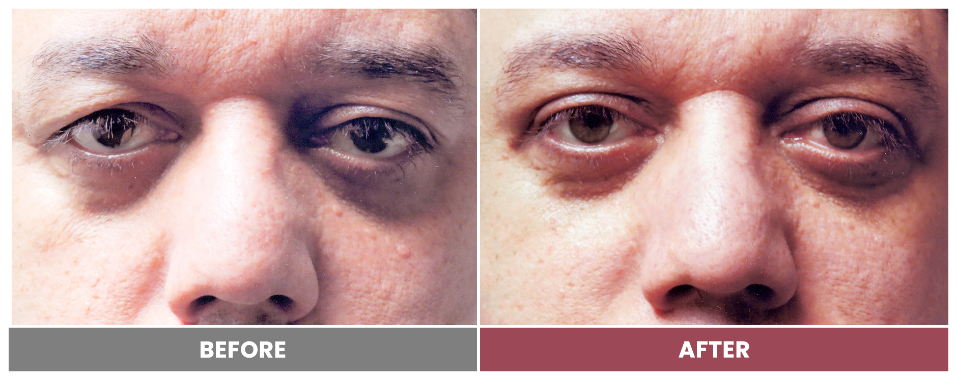 PTOSIS REPAIR - Case 65